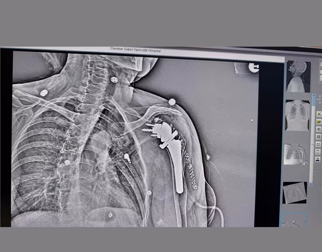 Robotic Reverse Shoulder Replacement in Pune